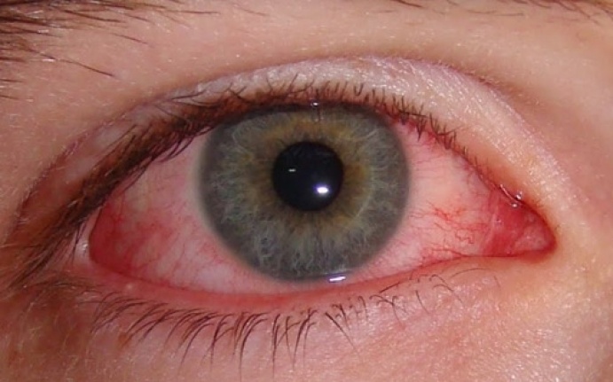 Korona virüs gözü de etkiliyor
